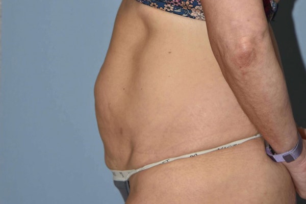 Tummy Tuck Before & After Gallery - Patient 173568945 - Image 7