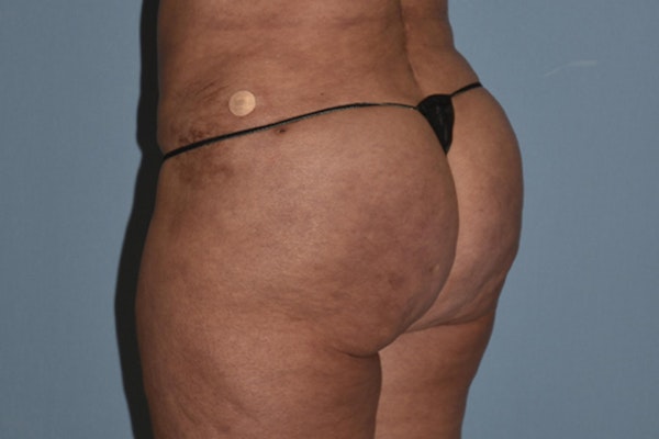 Brazilian Butt Lift Before & After Gallery - Patient 173568944 - Image 8