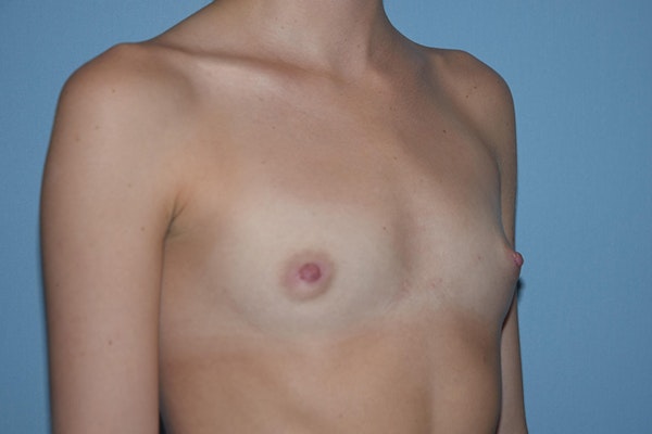 Breast Augmentation Before & After Gallery - Patient 173568947 - Image 5