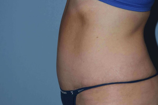 Tummy Tuck Before & After Gallery - Patient 173568945 - Image 8