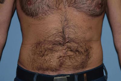 Liposuction Before & After Gallery - Patient 173568951 - Image 2