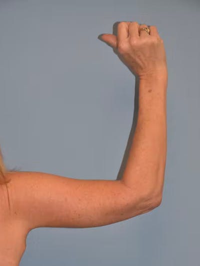 Arm Lift Before & After Gallery - Patient 173568946 - Image 4