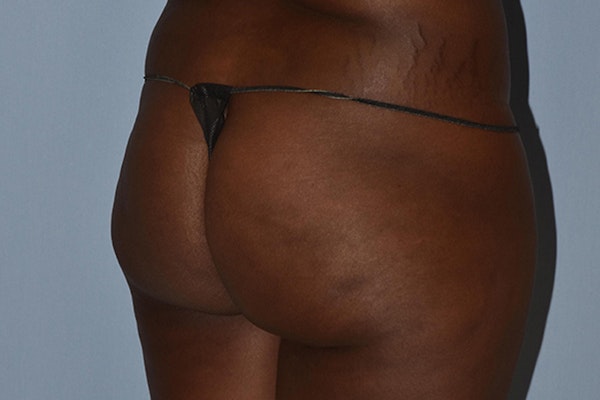Brazilian Butt Lift Before & After Gallery - Patient 173568949 - Image 1