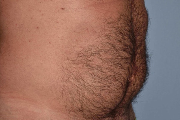 Liposuction Before & After Gallery - Patient 173568951 - Image 3