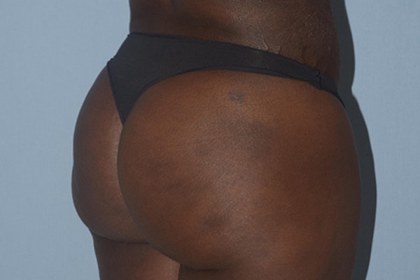Brazilian Butt Lift Before & After Gallery - Patient 173568949 - Image 2