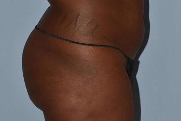 Brazilian Butt Lift Before & After Gallery - Patient 173568949 - Image 3