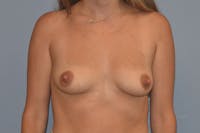 Breast Augmentation Before & After Gallery - Patient 173568956 - Image 1