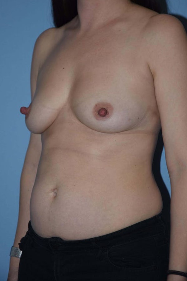 Mommy Makeover Before & After Gallery - Patient 173568950 - Image 7