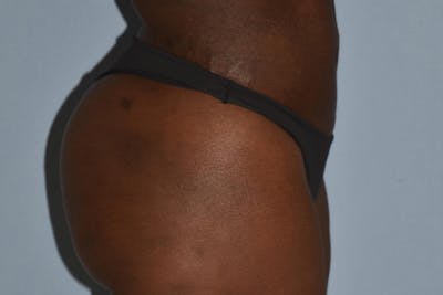Brazilian Butt Lift Before & After Gallery - Patient 173568949 - Image 4