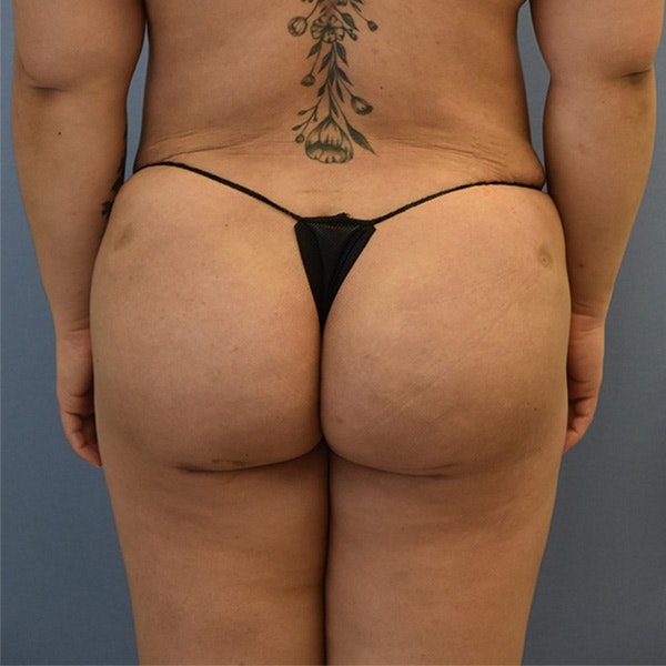 Brazilian Butt Lift Before & After Gallery - Patient 173568955 - Image 2