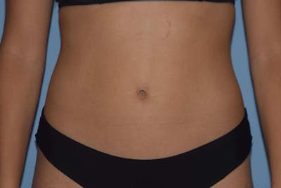 Liposuction Before & After Gallery - Patient 173568958 - Image 2