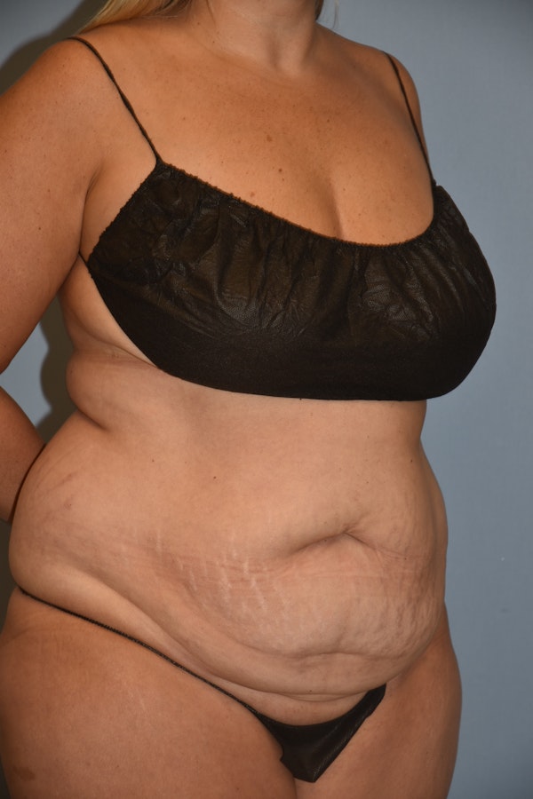 Tummy Tuck Before & After Gallery - Patient 173577827 - Image 3