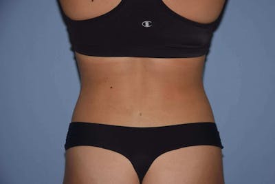 Liposuction Before & After Gallery - Patient 173568958 - Image 4