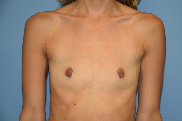 Breast Augmentation Before & After Gallery - Patient 173577816 - Image 1