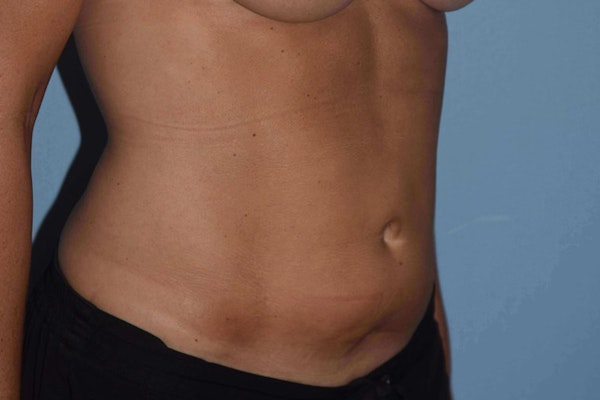 Liposuction Before & After Gallery - Patient 173577817 - Image 2