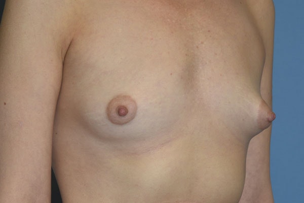 Breast Augmentation Before & After Gallery - Patient 173577814 - Image 3