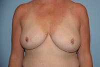 Breast Reduction Before & After Gallery - Patient 173577818 - Image 1