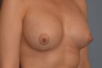 Breast Augmentation Before & After Gallery - Patient 173577814 - Image 4
