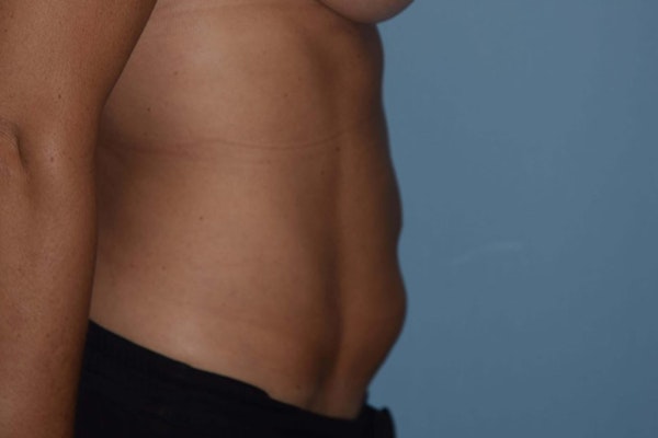 Liposuction Before & After Gallery - Patient 173577817 - Image 4