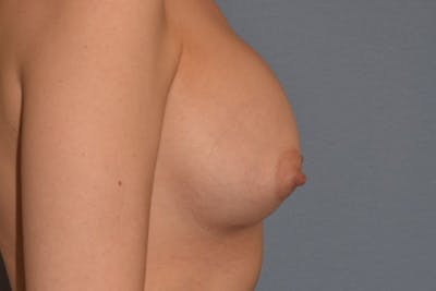 Breast Augmentation Before & After Gallery - Patient 173577814 - Image 6