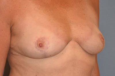 Breast Reduction Before & After Gallery - Patient 173577818 - Image 4