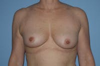 Breast Augmentation Before & After Gallery - Patient 173577824 - Image 1