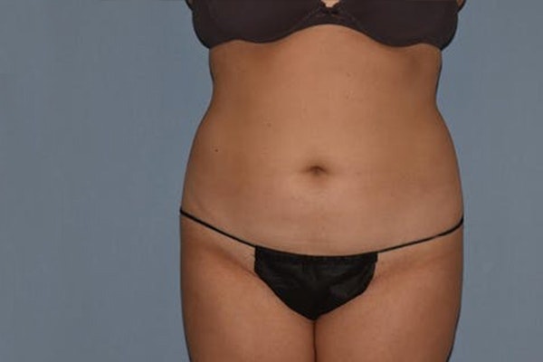 Liposuction Before & After Gallery - Patient 173577822 - Image 1
