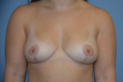 Breast Reduction Before & After Gallery - Patient 173577825 - Image 2