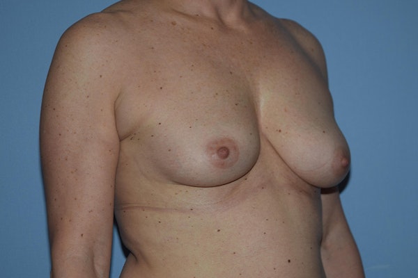 Breast Augmentation Before & After Gallery - Patient 173577824 - Image 3