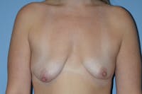 Breast Augmentation Lift Before & After Gallery - Patient 173577829 - Image 1