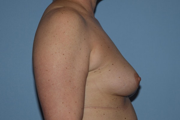 Breast Augmentation Before & After Gallery - Patient 173577824 - Image 5