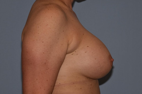 Breast Augmentation Before & After Gallery - Patient 173577824 - Image 6