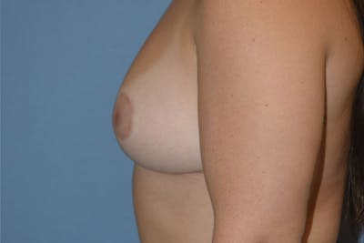 Breast Reduction Before & After Gallery - Patient 173577825 - Image 6