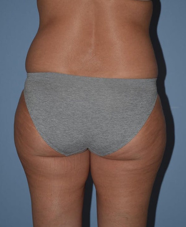 Liposuction Before & After Gallery - Patient 173577830 - Image 3