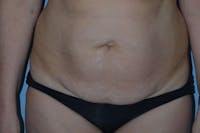 Tummy Tuck Before & After Gallery - Patient 173577832 - Image 1