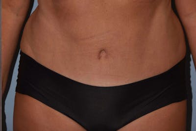 Tummy Tuck Before & After Gallery - Patient 173577832 - Image 2