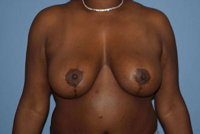 Breast Lift Before & After Gallery - Patient 173577835 - Image 2
