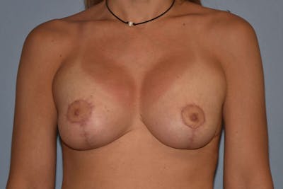 Breast Augmentation Lift Before & After Gallery - Patient 173577846 - Image 2