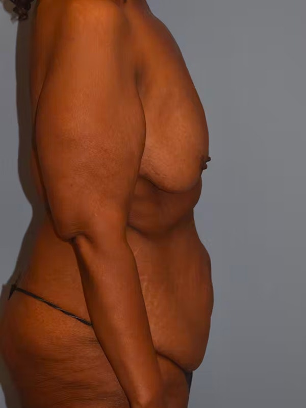 After Weight Loss Surgery Before & After Gallery - Patient 173577847 - Image 5