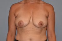 Breast Reduction Before & After Gallery - Patient 173577856 - Image 1