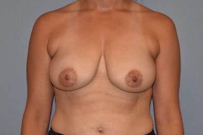 Breast Reduction Before & After Gallery - Patient 173577856 - Image 1
