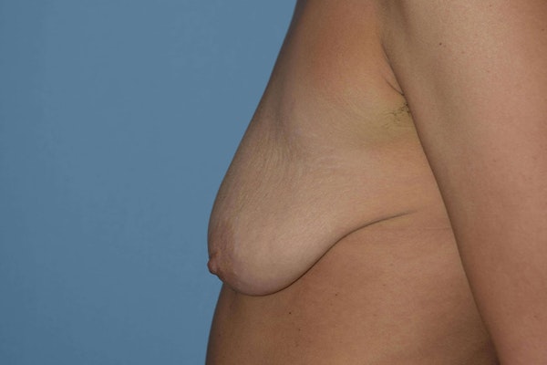 Breast Augmentation Lift Before & After Gallery - Patient 173577846 - Image 5