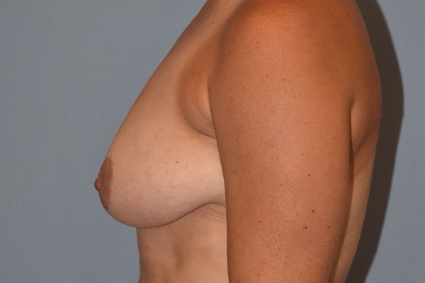 Breast Reduction Before & After Gallery - Patient 173577856 - Image 5