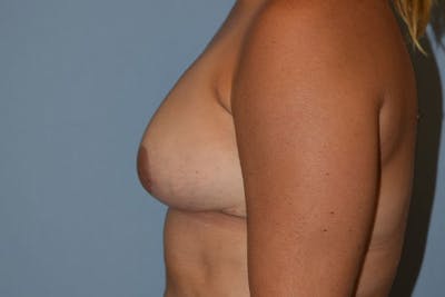 Breast Reduction Before & After Gallery - Patient 173577856 - Image 6