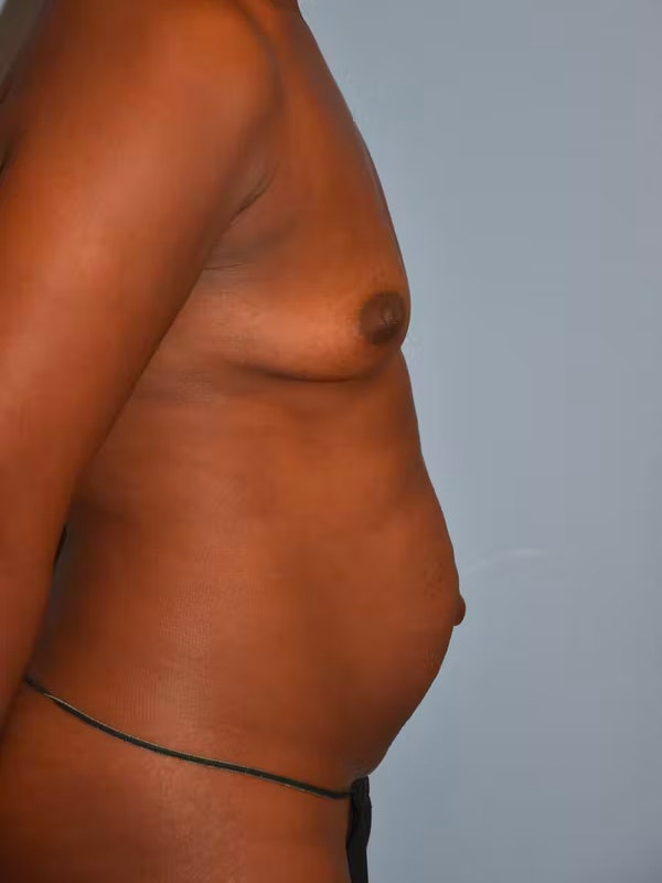 Mommy Makeover Before & After Gallery - Patient 173577857 - Image 5