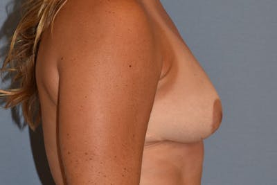 Breast Reduction Before & After Gallery - Patient 173577856 - Image 8