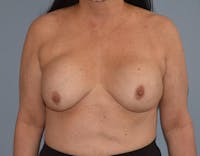 Breast Revision Before & After Gallery - Patient 173577870 - Image 1