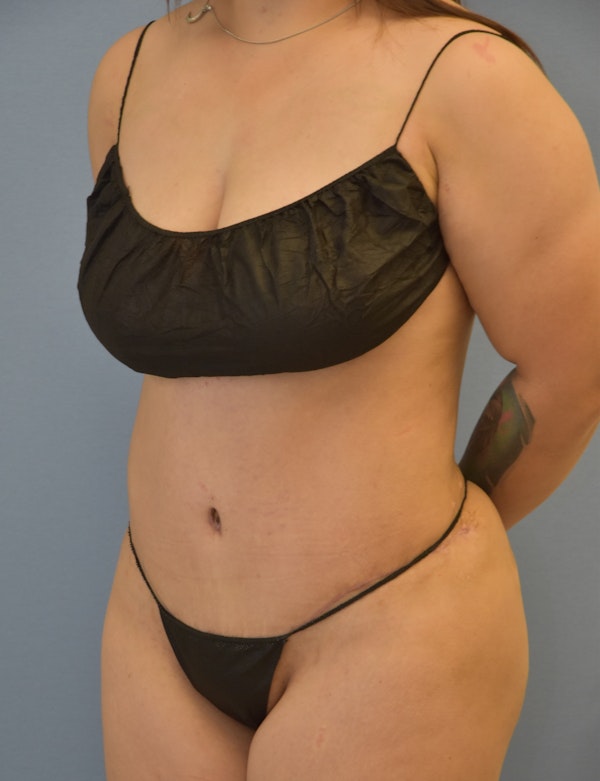 Tummy Tuck Before & After Gallery - Patient 173577861 - Image 4