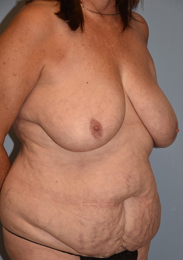 Mommy Makeover Before & After Gallery - Patient 173577865 - Image 3