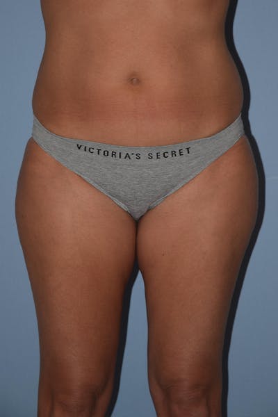 Liposuction Before & After Gallery - Patient 173577866 - Image 1